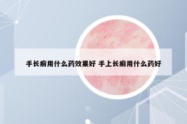 手长癣用什么药效果好 手上长癣用什么药好