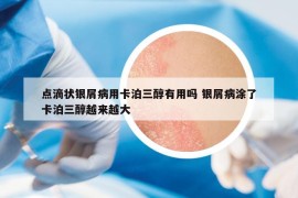 点滴状银屑病用卡泊三醇有用吗 银屑病涂了卡泊三醇越来越大