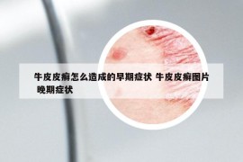 牛皮皮癣怎么造成的早期症状 牛皮皮癣图片 晚期症状