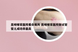 昆明哪家医院看白癜风 昆明哪家医院做试管婴儿成功率最高