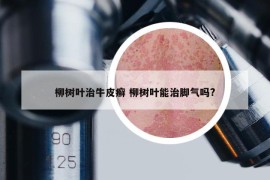 柳树叶治牛皮癣 柳树叶能治脚气吗?