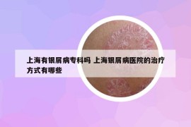 上海有银屑病专科吗 上海银屑病医院的治疗方式有哪些