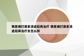 银屑病打激素消退后再治疗 银屑病打激素消退后再治疗会怎么样