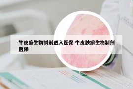 牛皮癣生物制剂进入医保 牛皮肤癣生物制剂医保