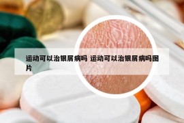 运动可以治银屑病吗 运动可以治银屑病吗图片