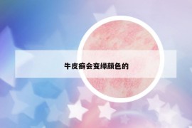 牛皮癣会变绿颜色的