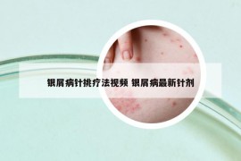 银屑病针挑疗法视频 银屑病最新针剂