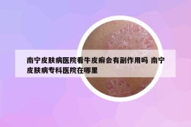 南宁皮肤病医院看牛皮癣会有副作用吗 南宁皮肤病专科医院在哪里