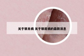 关于银肖病 关于银屑病的最新消息