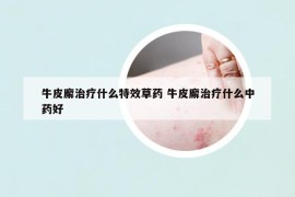 牛皮廨治疗什么特效草药 牛皮廨治疗什么中药好