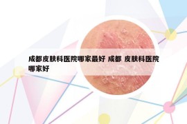 成都皮肤科医院哪家最好 成都 皮肤科医院哪家好