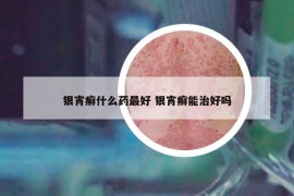 银宵癣什么药最好 银宵癣能治好吗