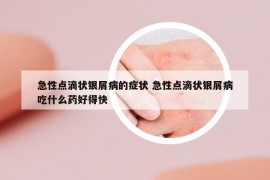 急性点滴状银屑病的症状 急性点滴状银屑病吃什么药好得快