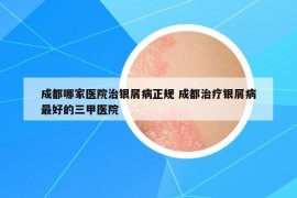 成都哪家医院治银屑病正规 成都治疗银屑病最好的三甲医院