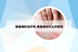 银翘病好治疗吗 银翘病吃什么药管用