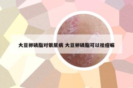 大豆卵磷脂对银屑病 大豆卵磷脂可以祛痘嘛