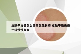 皮肤干皮是怎么回事就像长癣 皮肤干燥像癣一样慢慢变大