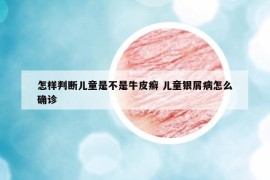 怎样判断儿童是不是牛皮癣 儿童银屑病怎么确诊