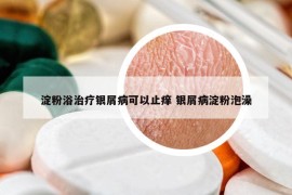 淀粉浴治疗银屑病可以止痒 银屑病淀粉泡澡