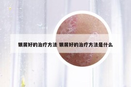 银屑好的治疗方法 银屑好的治疗方法是什么