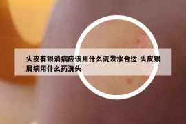 头皮有银消病应该用什么洗发水合适 头皮银屑病用什么药洗头