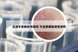 点滴牛皮癣会传染吗 牛皮肤癣输液管用吗