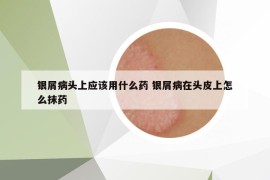 银屑病头上应该用什么药 银屑病在头皮上怎么抹药