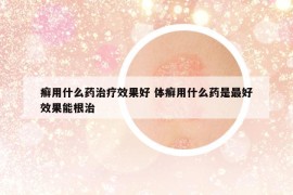 癣用什么药治疗效果好 体癣用什么药是最好效果能根治