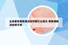 全身都有银屑病活检时取什么地方 银屑病做活检疼不疼