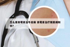 怎么用青霉素治牛皮癣 青霉素治疗银屑病如何?