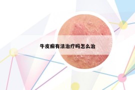 牛皮癣有法治疗吗怎么治