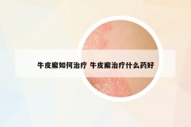 牛皮廨如何治疗 牛皮廨治疗什么药好