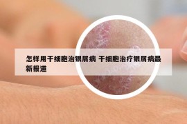 怎样用干细胞治银屑病 干细胞治疗银屑病最新报道