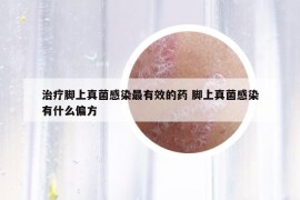 治疗脚上真菌感染最有效的药 脚上真菌感染有什么偏方