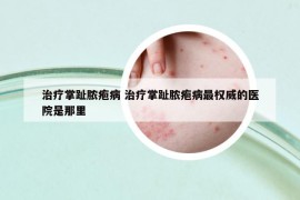 治疗掌趾脓疱病 治疗掌趾脓疱病最权威的医院是那里