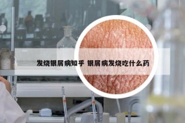 发烧银屑病知乎 银屑病发烧吃什么药