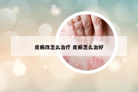 皮癣改怎么治疗 皮癣怎么治好