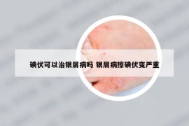 碘伏可以治银屑病吗 银屑病擦碘伏变严重