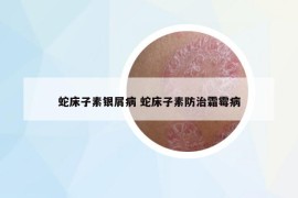 蛇床子素银屑病 蛇床子素防治霜霉病