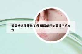 银屑病还能要孩子吗 银屑病还能要孩子吗女性