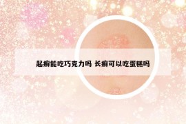 起癣能吃巧克力吗 长癣可以吃蛋糕吗