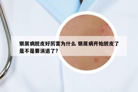 银屑病脱皮好厉害为什么 银屑病开始脱皮了是不是要消退了?