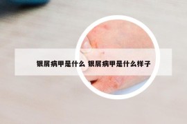 银屑病甲是什么 银屑病甲是什么样子