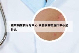 银屑病生物治疗中心 银屑病生物治疗中心是什么