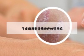 牛皮癣用紫外线光疗仪管用吗