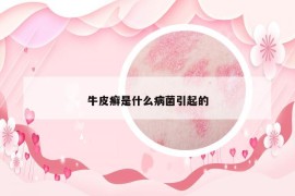 牛皮癣是什么病菌引起的