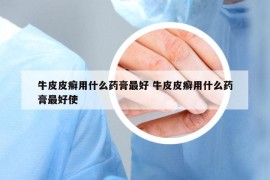 牛皮皮癣用什么药膏最好 牛皮皮癣用什么药膏最好使