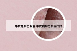 牛皮急癣怎么治 牛皮病癣怎么治疗好