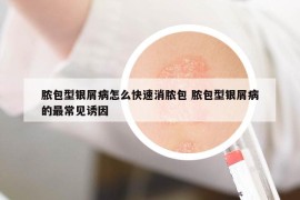 脓包型银屑病怎么快速消脓包 脓包型银屑病的最常见诱因