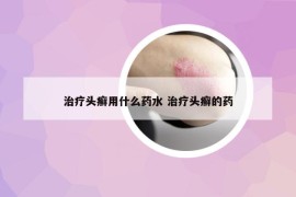 治疗头癣用什么药水 治疗头癣的药